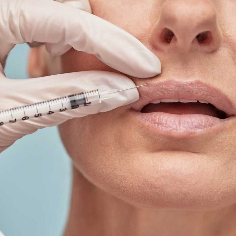 Smoker’s Lips Treatment in Abu Dhabi