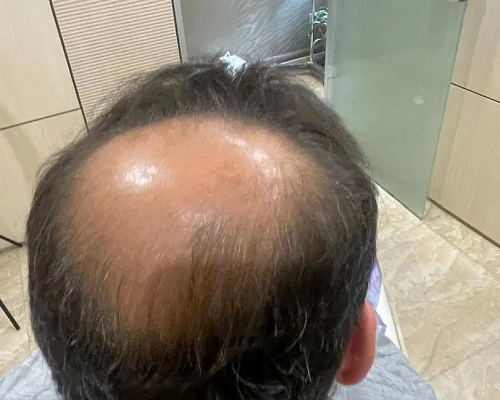 Crown Hair Transplant in Abu Dhabi