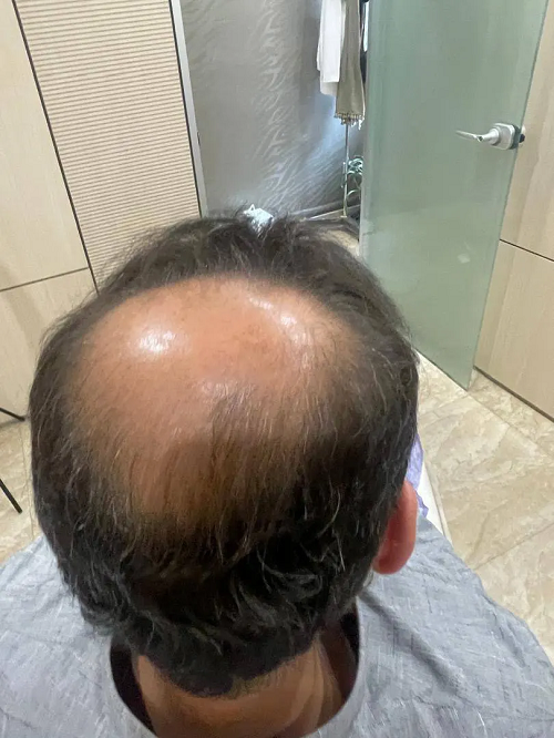 Crown Hair Transplant in Abu Dhabi