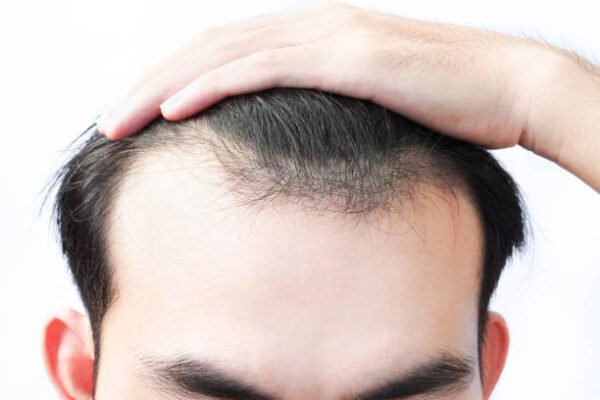 Is G Cell Treatment effective for thinning crown hair