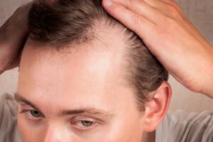 Is GFC Treatment for Hair useful for seasonal hair fall