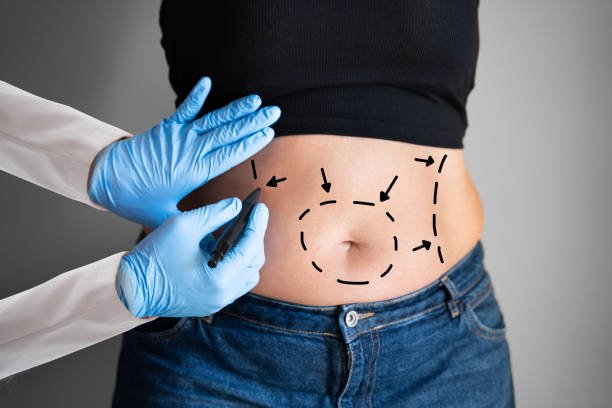 Is Lipo Abdominoplasty right for loose abdominal skin