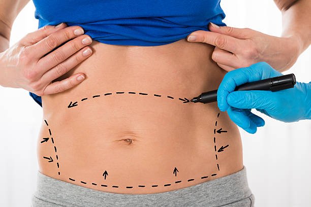Is Liposuction suitable for a healthy-weight patient