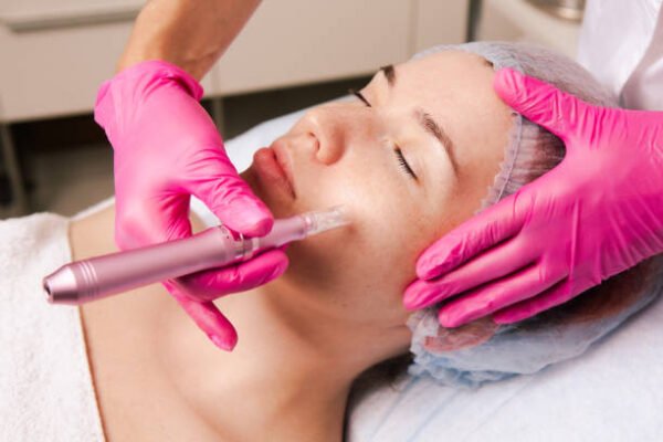 Is Microneedling suitable for acne-prone facial skin