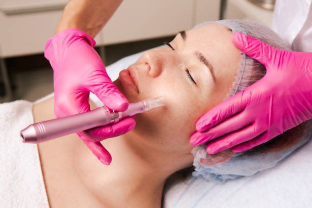 Is Microneedling suitable for acne-prone facial skin