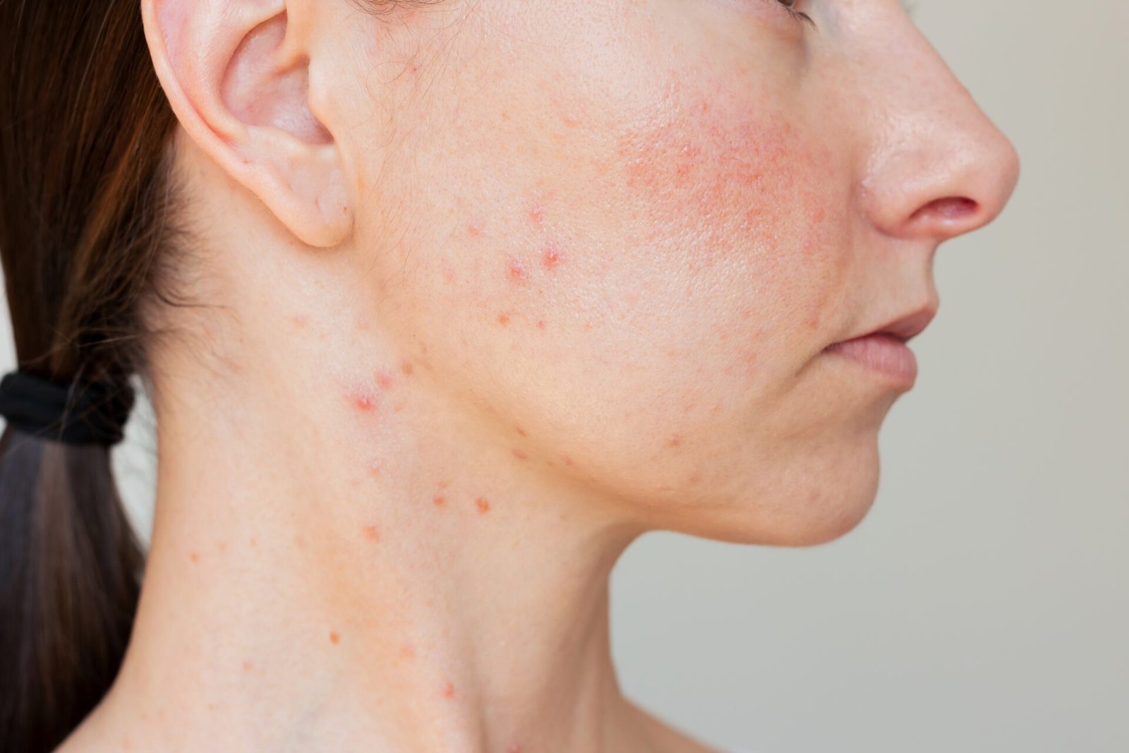 Skin Diseases Treatment in Abu Dhabi