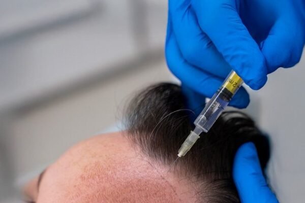 Stem Cell Hair Transplant in Abu Dhabi