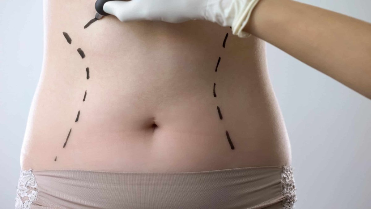 Tummy Tuck Abu Dhabi