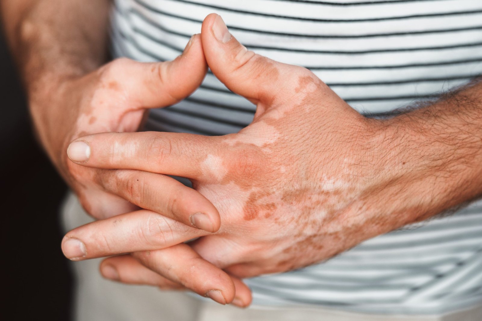 Vitiligo treatment in Abu Dhabi