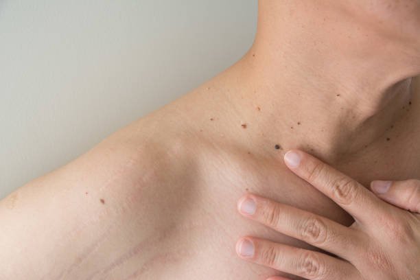 Is Warts Removal Treatment suitable for neck warts