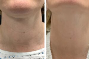 Radiofrequency (RF) Microneedling in Dubai for Customized Skin Goals