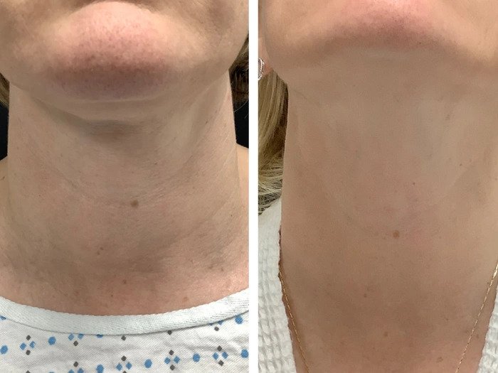 Radiofrequency (RF) Microneedling Treatments in Dubai for Advanced Skin Remodeling