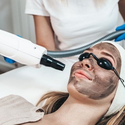 Laser Carbon Peel