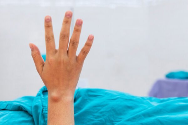Lipoma Treatment