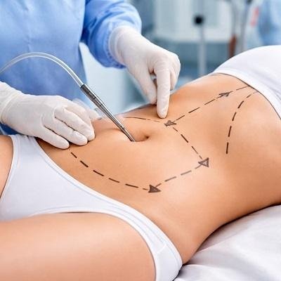 Liposuction Surgery