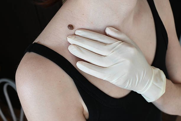 What Makes Mole Removal a Popular Treatment