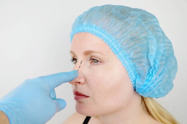 What Results Can You Expect After Rhinoplasty Treatment