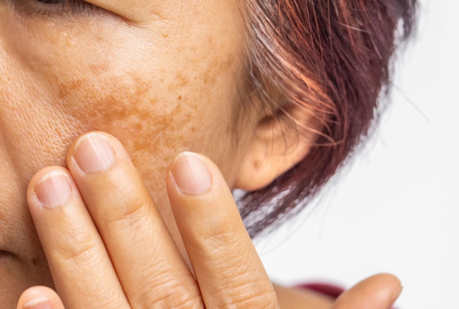 Pigmentation Treatment in Abu Dhabi