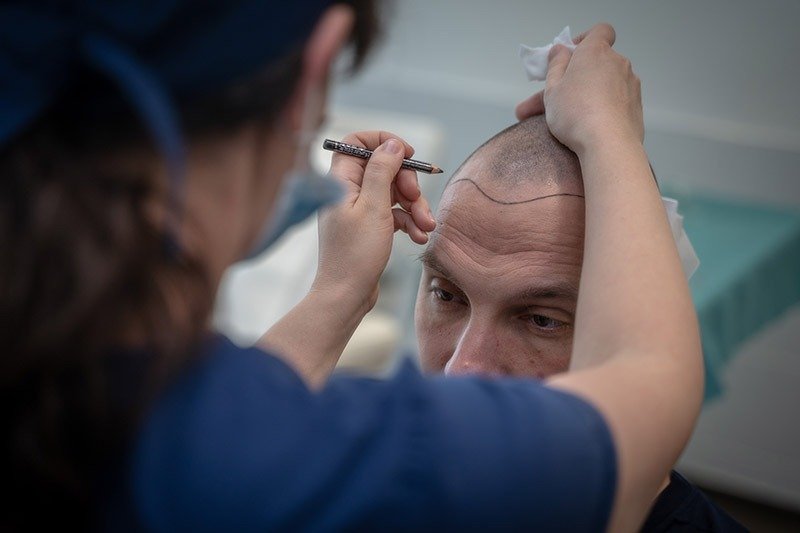 Scalp Micropigmentation