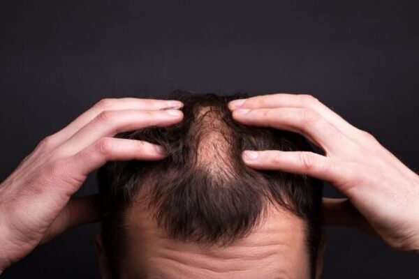 hair loss treatment in Dubai