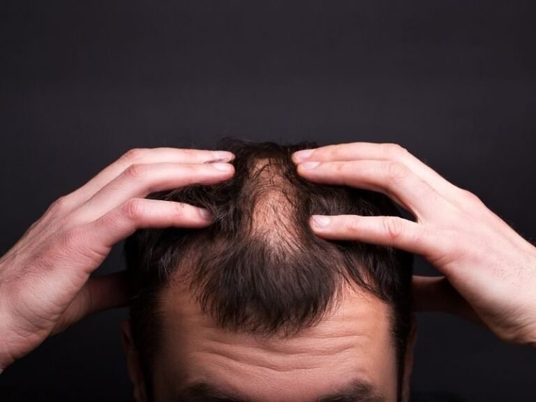 hair loss treatment in Dubai