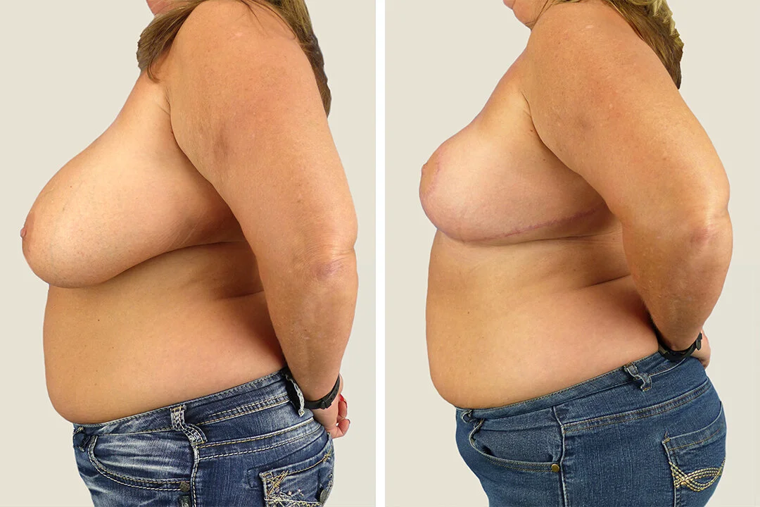 Breast Reduction Surgery Cost