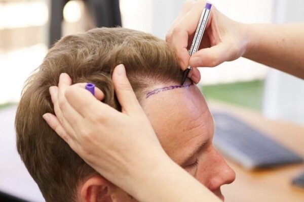 Hair Transplant in Dubai