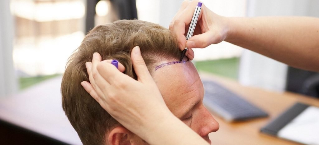 Hair Transplant in Dubai