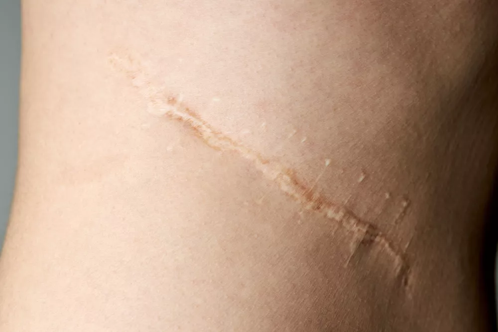 Surgical Scar Revision