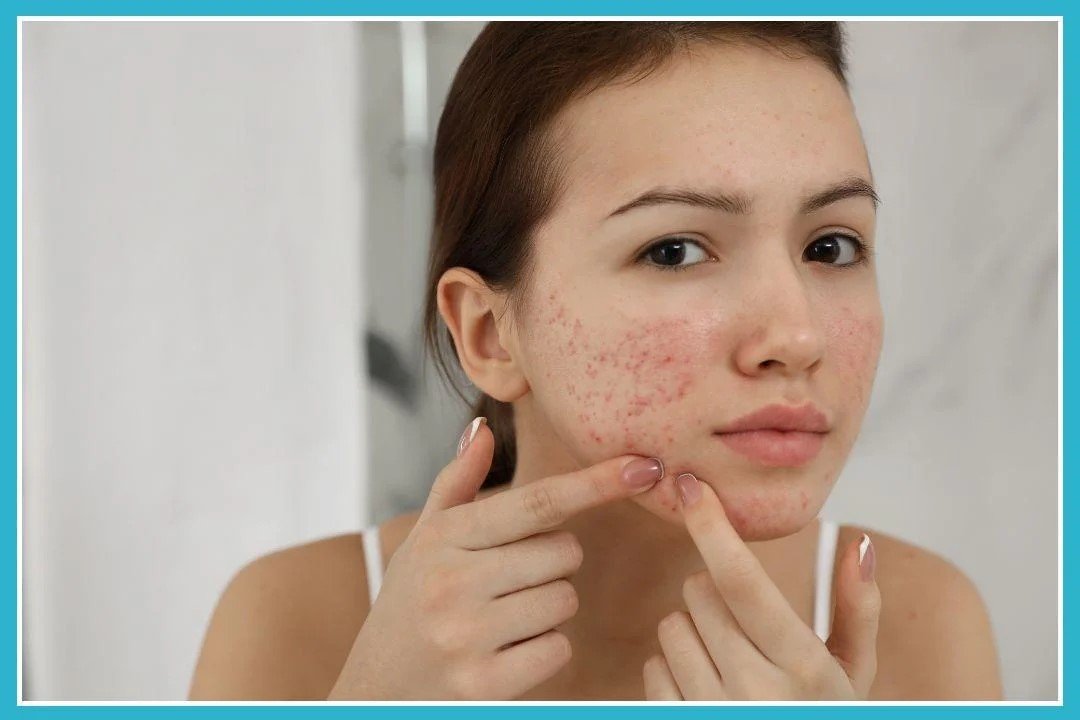 Accufine 5 mg for acne