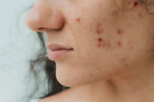 Can Acne Treatment Help With Forehead Breakouts