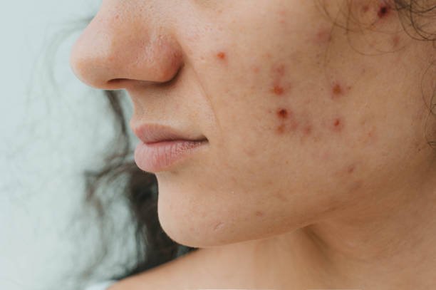 Can Acne Treatment Help With Forehead Breakouts