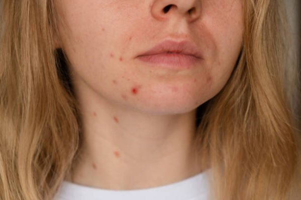 Can Laser Acne Scar treatment Improve Facial Texture