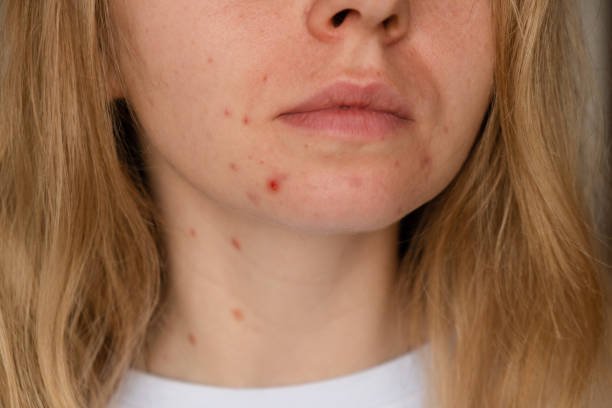 Can Laser Acne Scar treatment Improve Facial Texture