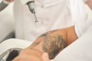 Can Laser Tattoo Removal restore clearer-looking skin