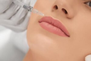 Can Lip Filler Injections Improve Upper Lip Projection