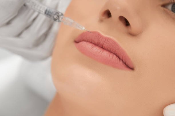 Can Lip Filler Injections Improve Upper Lip Projection