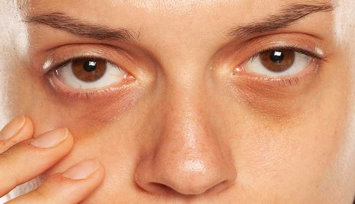 Dark Circles Treatment in Islamabad
