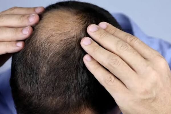 Crown Hair Transplant in Abu Dhabi
