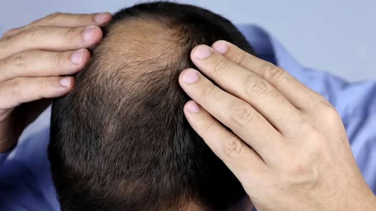 Crown Hair Transplant in Abu Dhabi