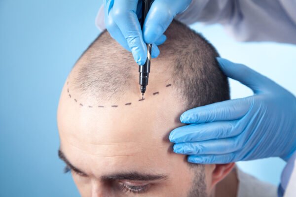Hair Transplant in Abu Dhabi