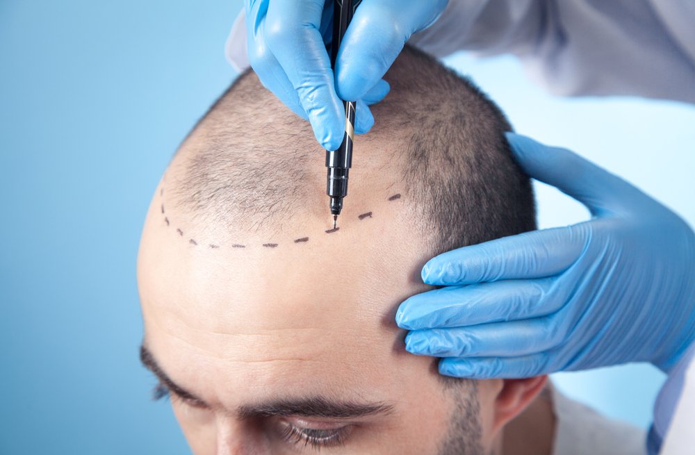 Hair Transplant in Abu Dhabi