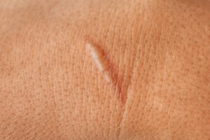 Keloid Treatment Abu Dhabi