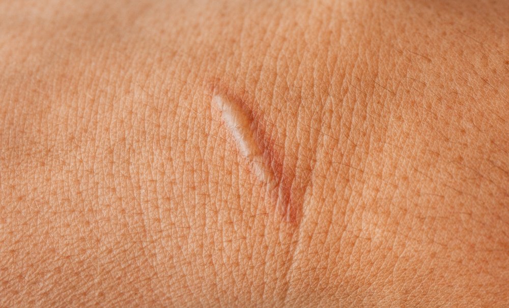 Keloid Treatment Abu Dhabi
