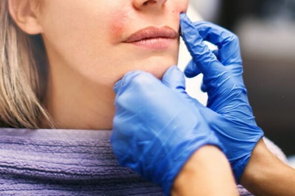 Subcision Treatment for Acne Scars in Abu Dhabi