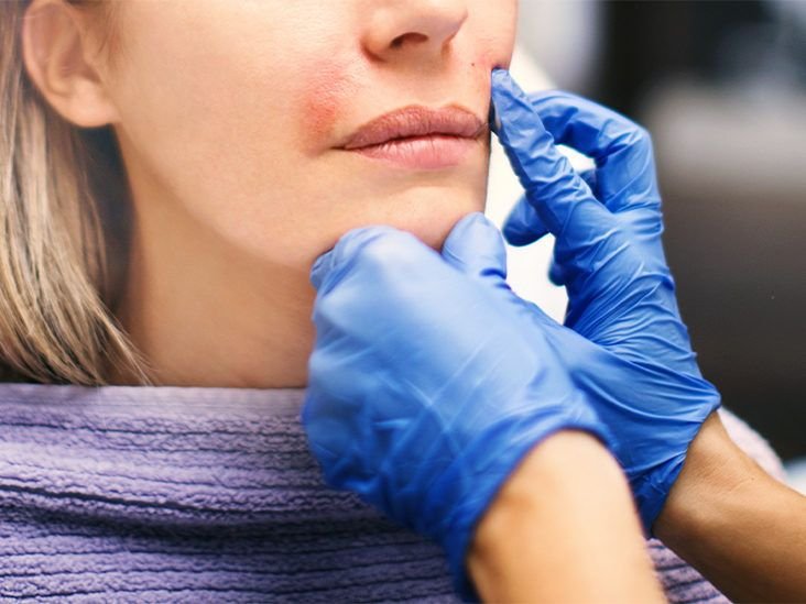 Subcision Treatment for Acne Scars in Abu Dhabi