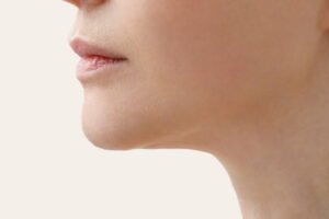 Double Chin Removal in Islamabad