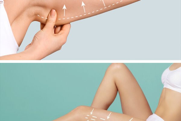 Fat Removal Surgery