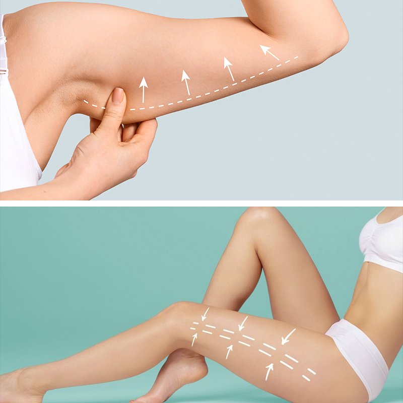 Fat Removal Surgery