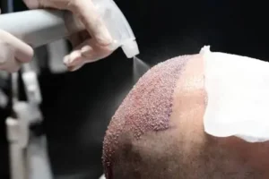 Hair Transplant An Individualized Approach